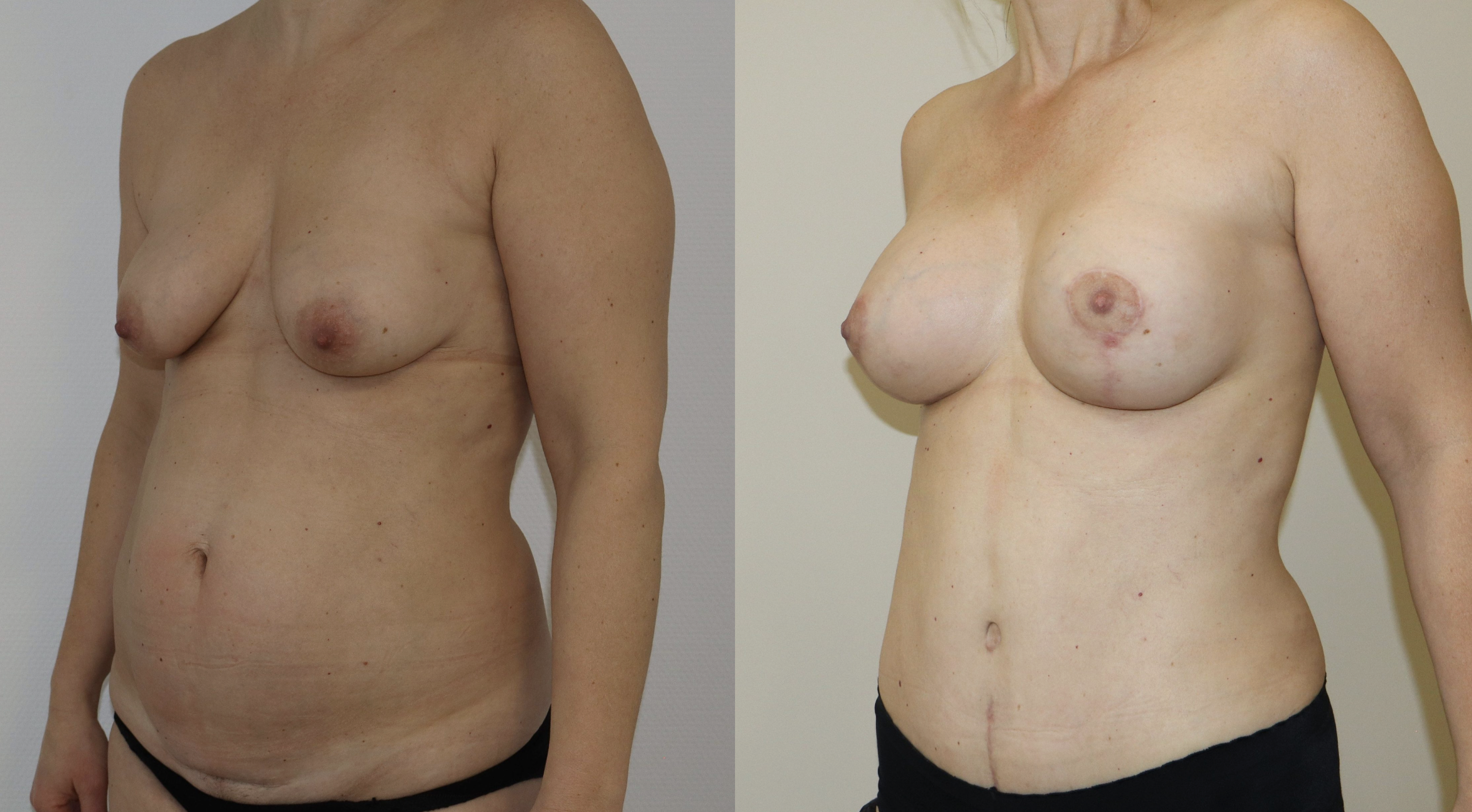 Avant/Après mommy makeover